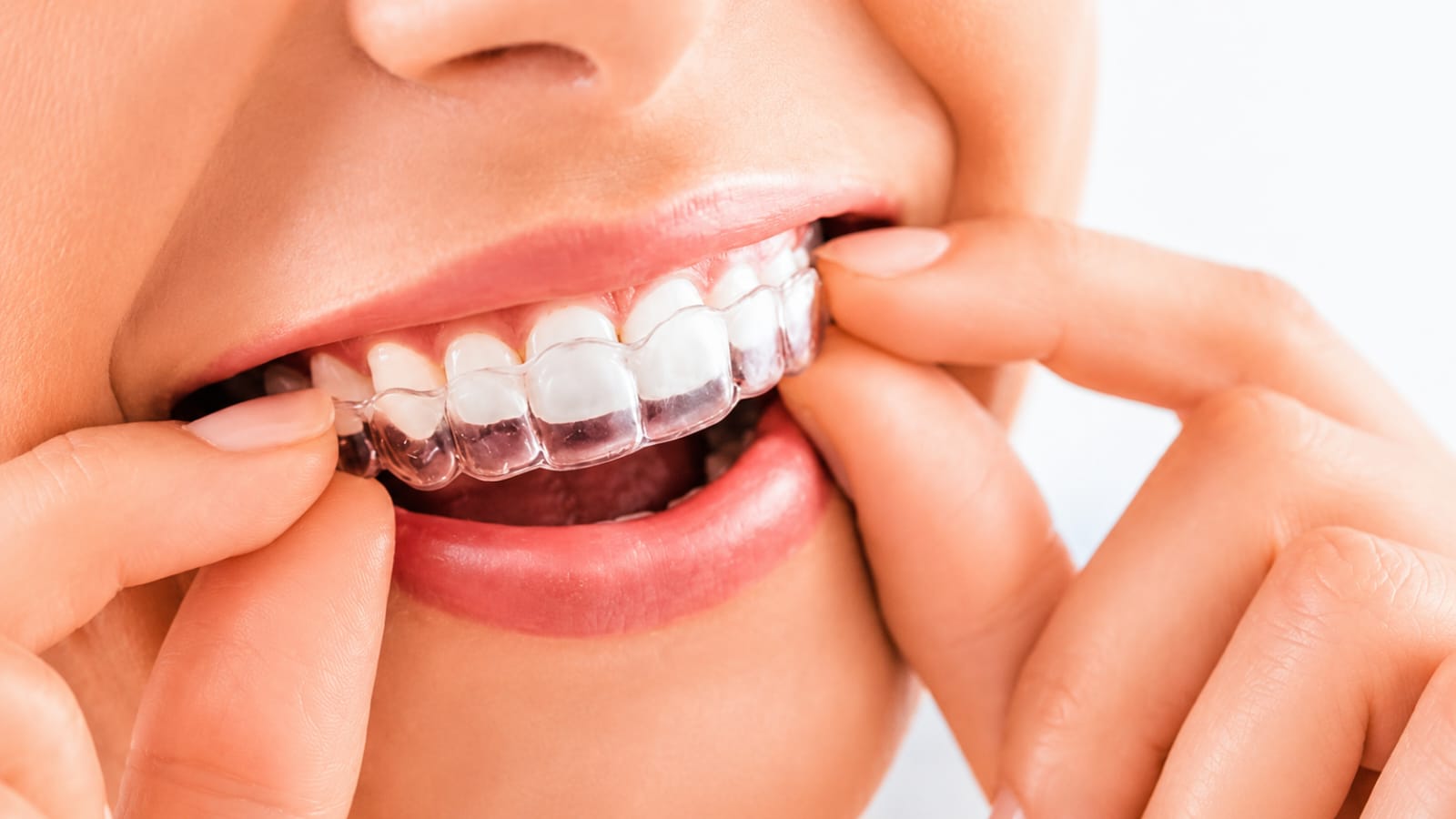 Clear Aligners